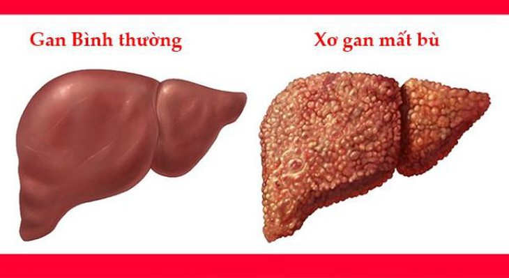 Tiềm ẩn tác dụng phụ nghiêm trọng khi dùng albumin ở bệnh nhân xơ gan mất bù